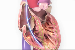 Illustration of an ICD