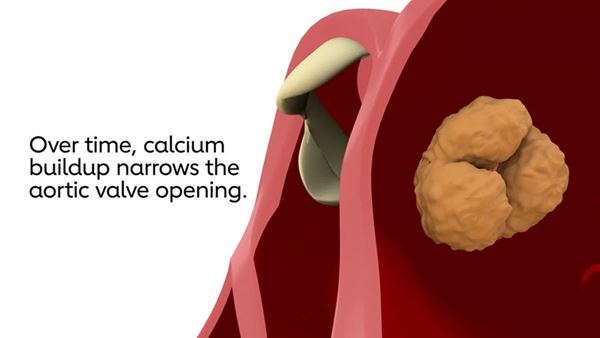 What is aortic stenosis video